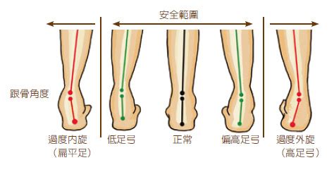 外八字腳|足內旋 (入字腳) 與足外旋 (八字腳) 